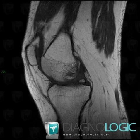 Meniscal ossicle, Meniscus, MRI