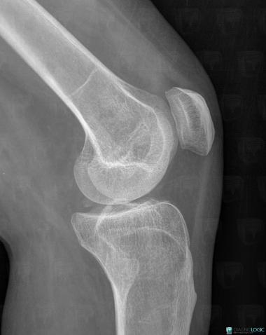 Meniscal ossicle, Meniscus, X rays