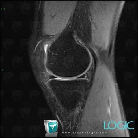 Radiology case : Anterior cruciate ligament rupture (MRI) - Diagnologic