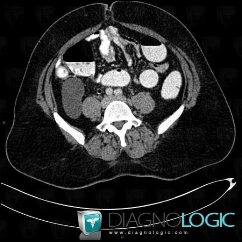 Mesenteric cyst, Mesentery / Peritoneum, CT