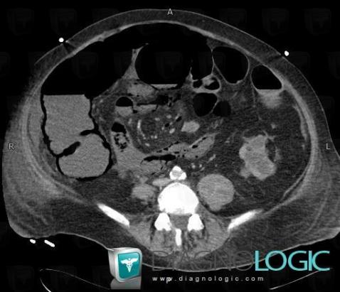 Mesenteric ischemia, Small bowel, CT