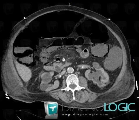 Mesenteric ischemia, Small bowel, CT