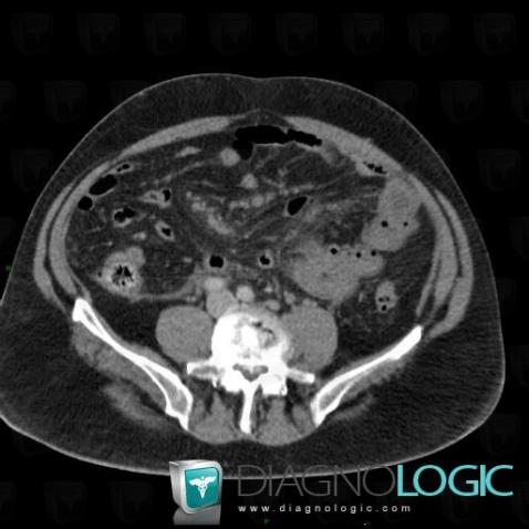 Mesenteric ischemia, Small bowel, CT