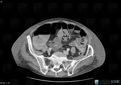 Mesenteric ischemia, Small bowel, CT