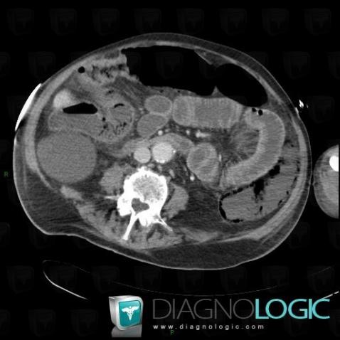 Mesenteric ischemia, Small bowel, CT