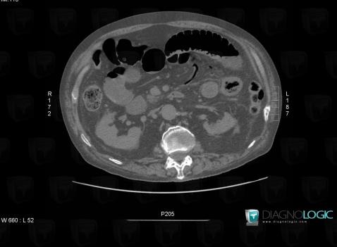 Mesenteric veins gas, Portal vein and branches, CT