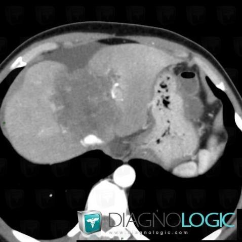 Mesothelial cyst, Mesentery / Peritoneum, CT