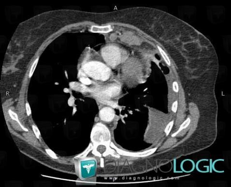 Mesothelioma, Mediastinum, CT