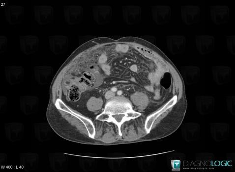 Mesothelioma, Mesentery / Peritoneum, CT