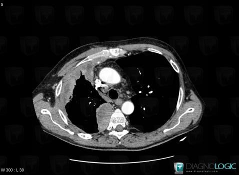 Mesothelioma, Pleura, CT