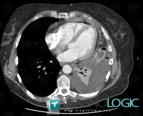 Mesothelioma, Pleura, CT