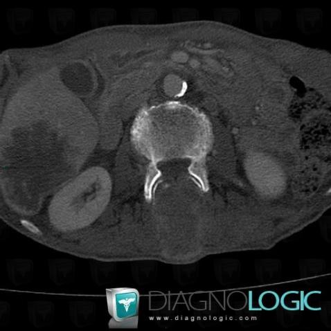 Métastase, Corps vertébral / Disque, Scanner