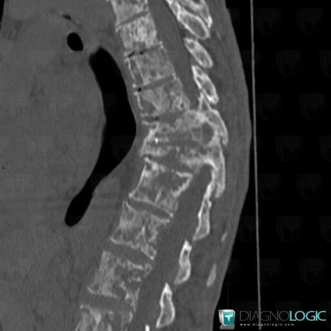 Métastase, Corps vertébral / Disque, Scanner