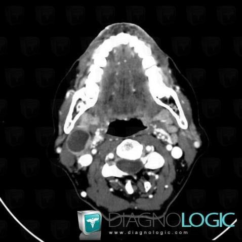 Métastase, Espaces profonds-cou, Scanner