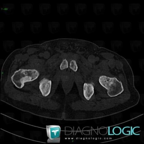 Métastase, Fémur -supérieur, Scanner