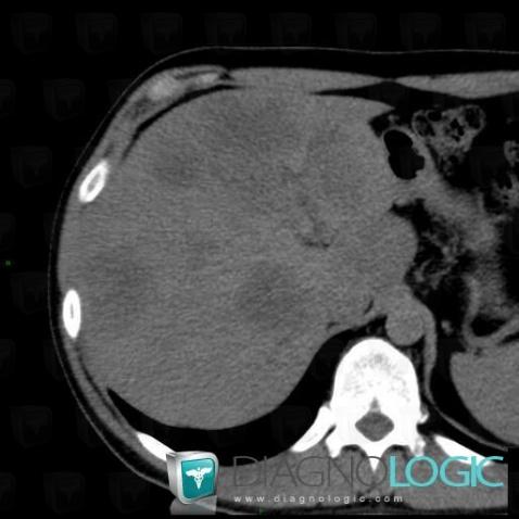 Cas radiologie : Métastase (Scanner) - Diagnologic