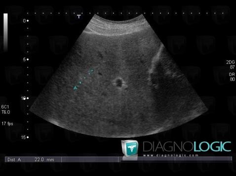 Métastase, Foie, Echographie