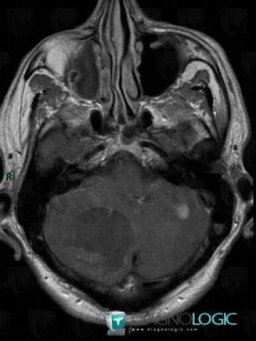 Métastase, Fosse postérieure, IRM
