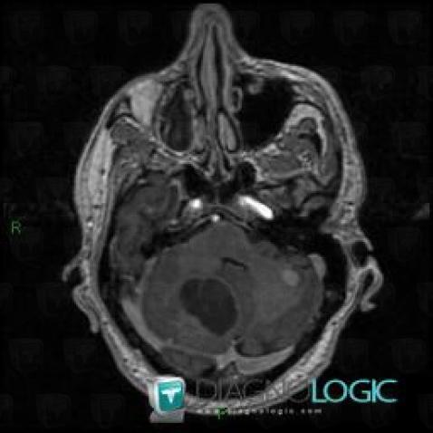 Métastase, Fosse postérieure, IRM