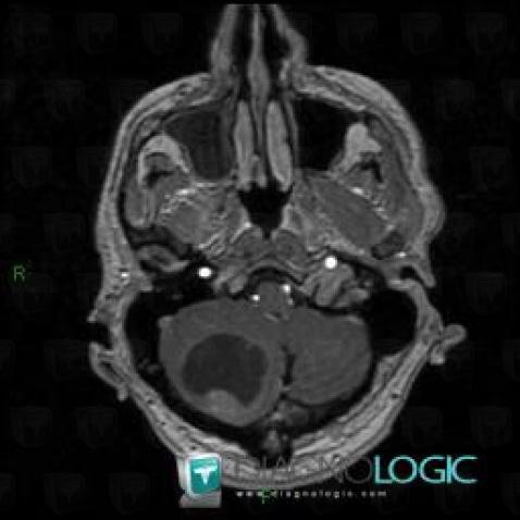 Métastase, Fosse postérieure, IRM