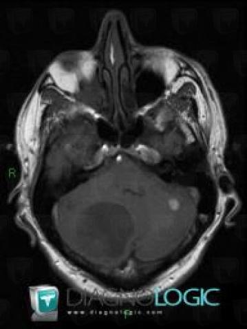 Métastase, Fosse postérieure, IRM
