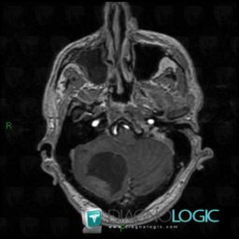 Métastase, Hémisphère cérébelleux, IRM