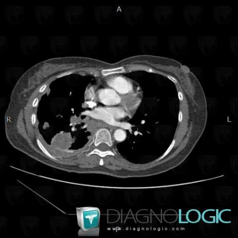 Métastase, Médiastin, Scanner
