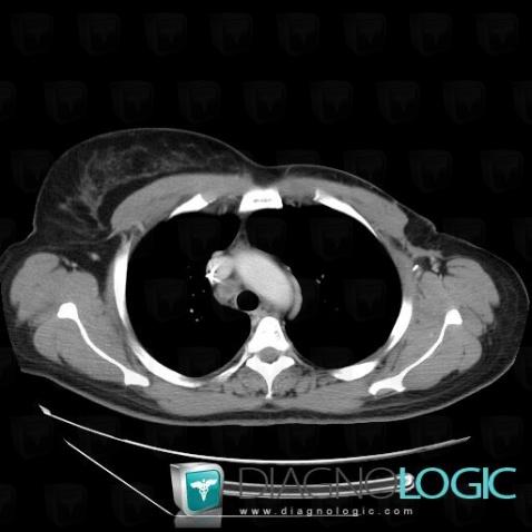 Métastase, Médiastin, Scanner
