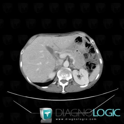 Cas radiologie : Métastase (Scanner) - Diagnologic