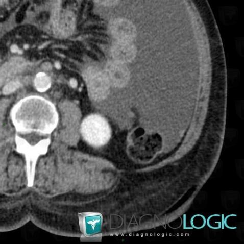 Cas radiologie : Métastase (Scanner) - Diagnologic