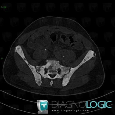 Métastase, Os iliaque, Sacrum / Coccyx, Scanner