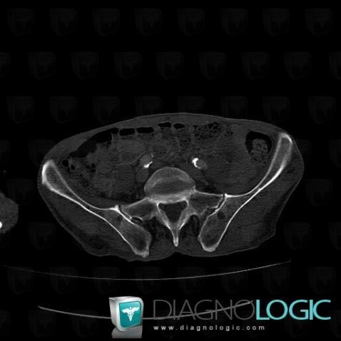 Métastase, Os iliaque, Scanner
