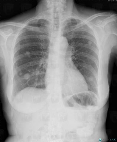 Métastase, Parenchyme pulmonaire, Radio