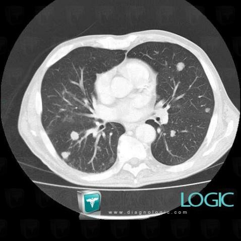 Métastase, Parenchyme pulmonaire, Scanner