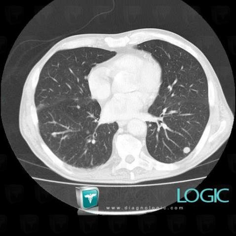 Métastase, Parenchyme pulmonaire, Scanner