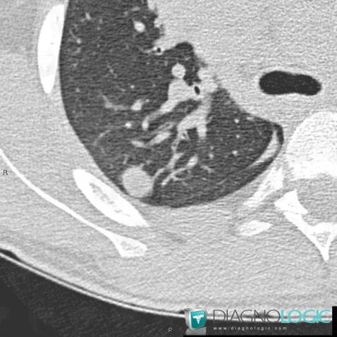 Métastase, Parenchyme pulmonaire, Scanner