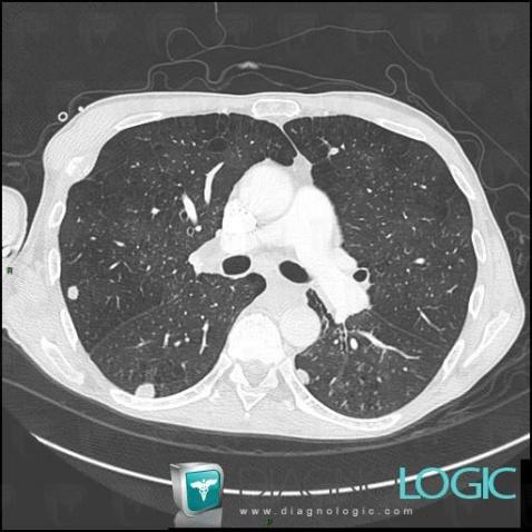 Métastase, Parenchyme pulmonaire, Scanner