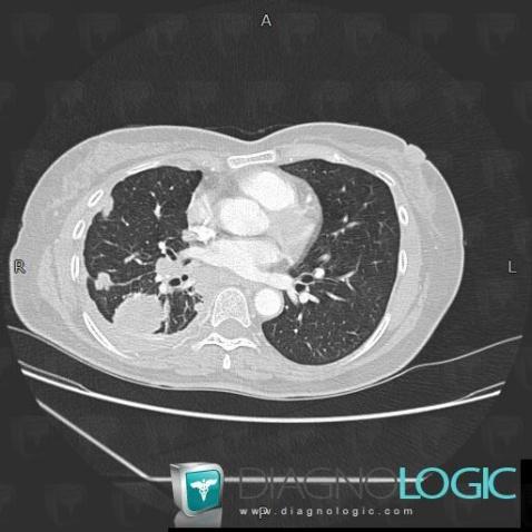 Métastase, Parenchyme pulmonaire, Scanner