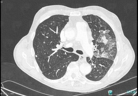 Métastase, Parenchyme pulmonaire, Scanner