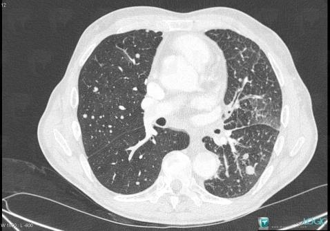 Métastase, Parenchyme pulmonaire, Scanner