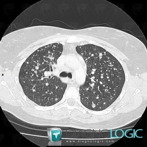 Métastase, Parenchyme pulmonaire, Scanner