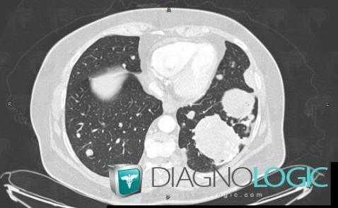 Métastase, Parenchyme pulmonaire, Scanner