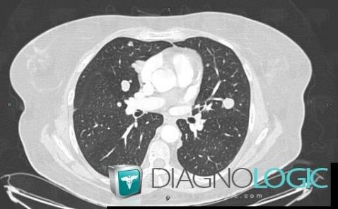 Métastase, Parenchyme pulmonaire, Scanner