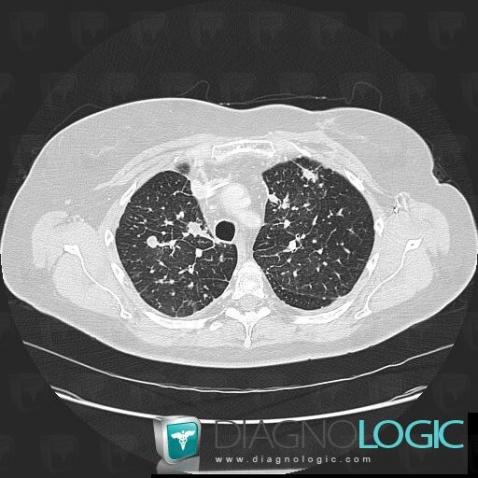 Métastase, Parenchyme pulmonaire, Scanner