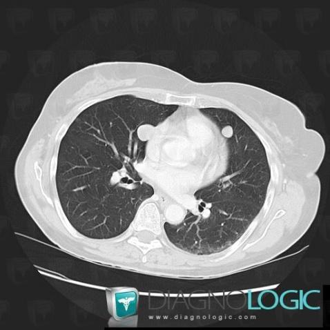 Métastase, Parenchyme pulmonaire, Scanner