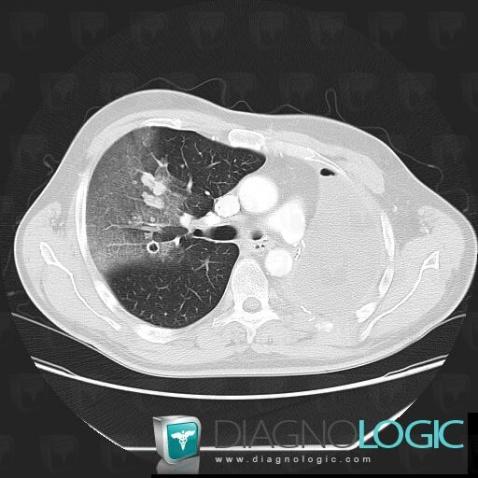 Métastase, Parenchyme pulmonaire, Scanner