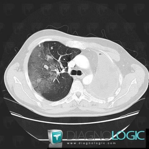 Métastase, Parenchyme pulmonaire, Scanner