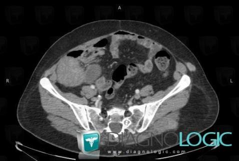 Métastase, Paroi abdominale, Scanner