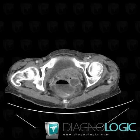 Métastase, Pelvis / Périnée, Scanner
