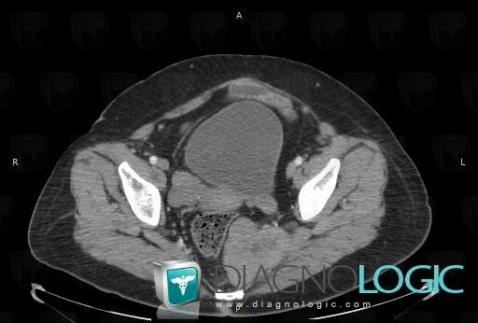 Métastase, Rectum, Pelvis / Périnée, Scanner